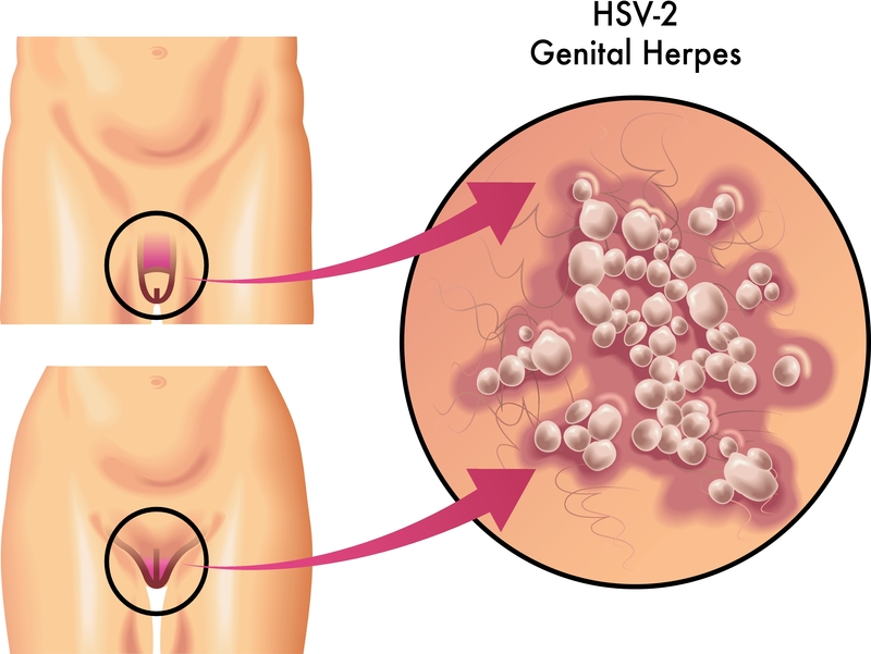 Herpes an der scheide behandlung