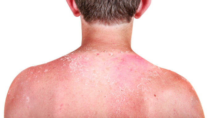 teaserimage-Homöopathie bei Sonnenbrand bei Kindern
